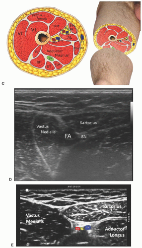 Ultrasound-Guided Saphenous Nerve Block of the Thigh, Knee ...