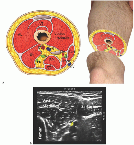 Ultrasound-Guided Saphenous Nerve Block of the Thigh, Knee, and Ankle