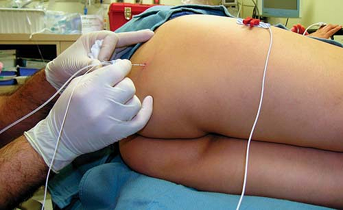 Sciatic Nerve Blocks Anesthesia Key