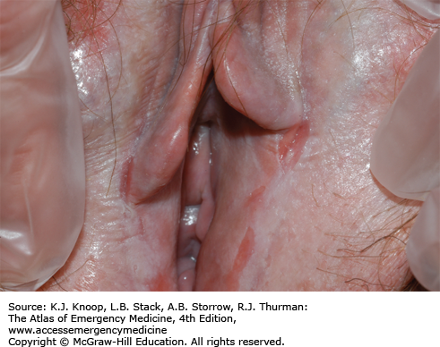 Lichen planus oral steroids