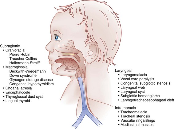 Pediatric Respiratory Emergencies: Upper Airway Obstruction and