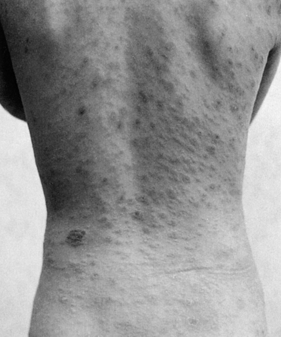 Pityriasis Rosea Anesthesia Key Pityriasis Rosea Anesthesia Key