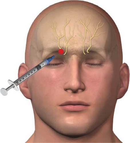 Common Nerve Blocks Anesthesia Key