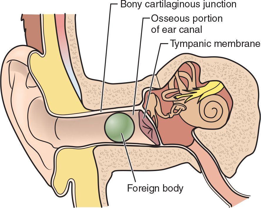 What Is The Difference Between Mild And Serious Foreign Bodies In The Ear