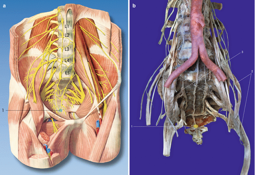 Superior Hypogastric Plexus and Ganglion Impar Block | Anesthesia Key