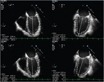 Chapter 33 – Assessment Of Ventricular Function | Anesthesia Key