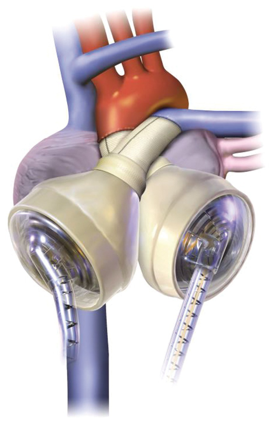 chapter-16-ventricular-assist-device-implantation-anesthesia-key