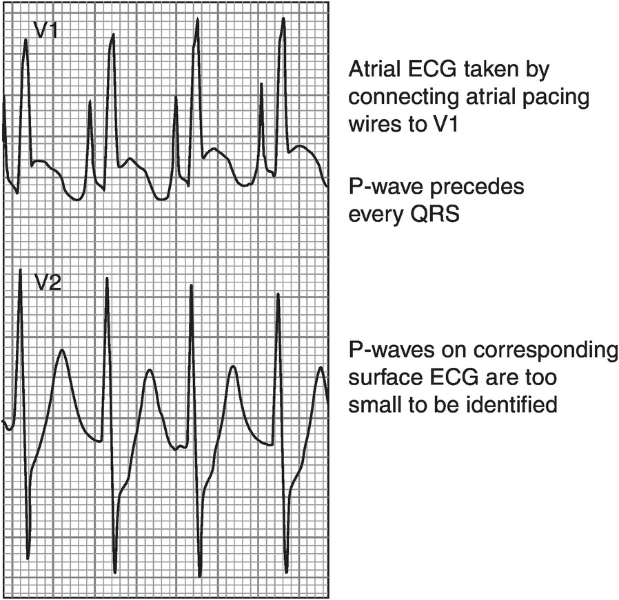 Chapter 22 – Postoperative Paediatric Care 