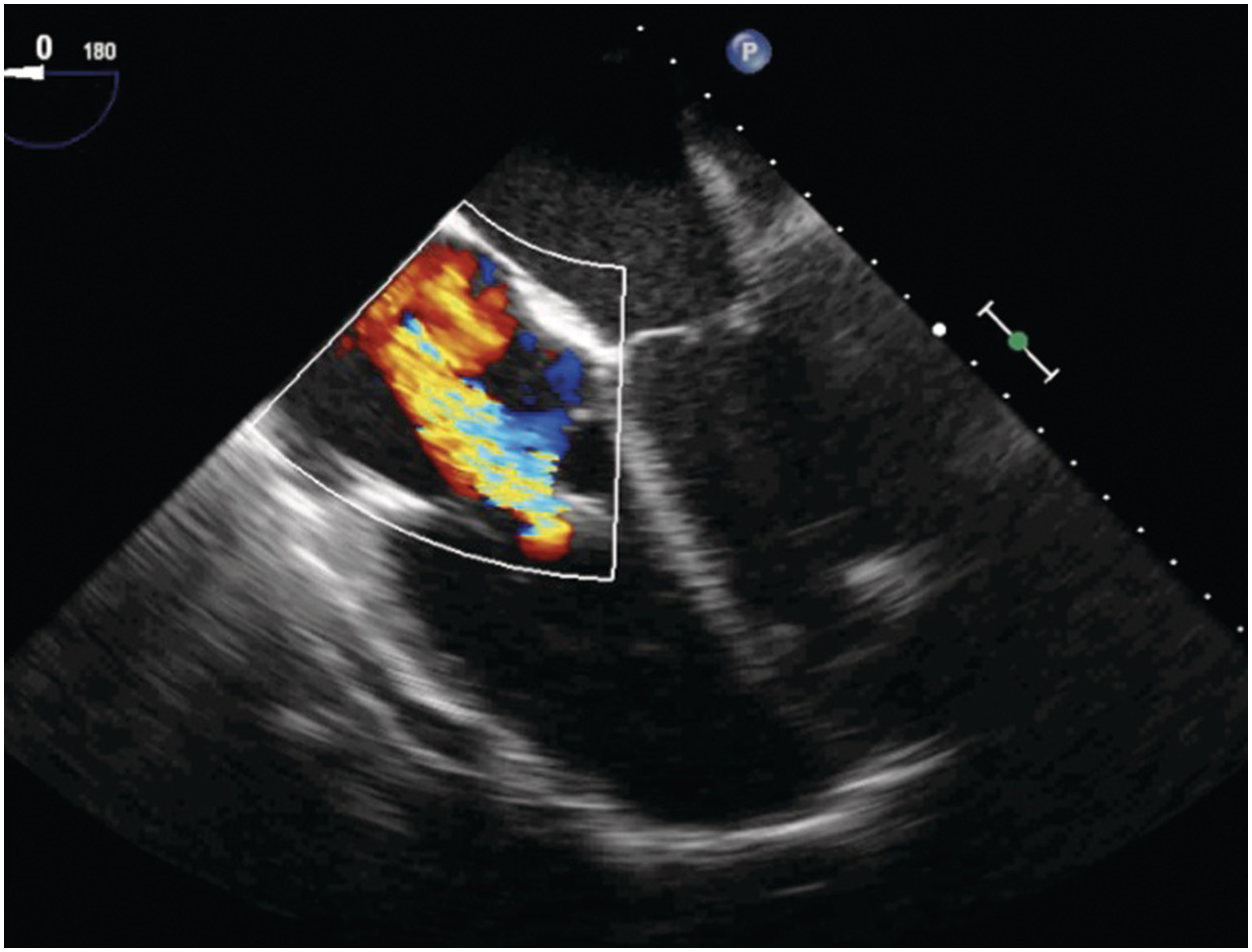 Chapter 34 assessment of valvular heart disease anesthesia key