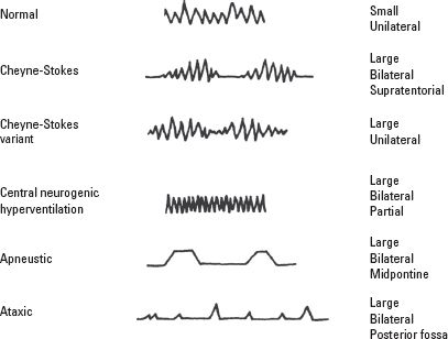 Tidal volume of some abnormal breathing patterns: a) Cheyne-Stokes