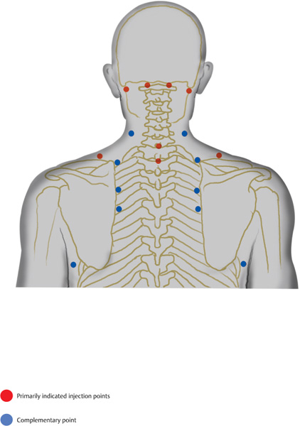 Myofascial Pain Syndromes | Anesthesia Key