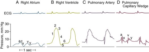 pulmonary artery catheter waveforms