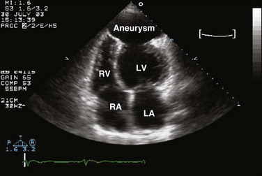 Echocardiography | Anesthesia Key
