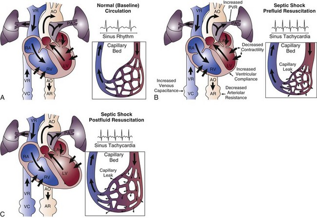 Septic Shock | Anesthesia Key