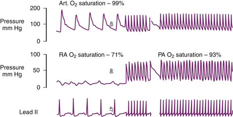 Mechanical Complications Of Acute Myocardial Infarction | Anesthesia Key