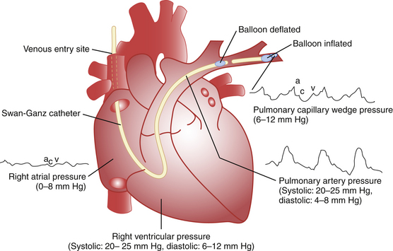 Invasive Hemodynamic Monitoring in the Cardiac Intensive Care Unit ...