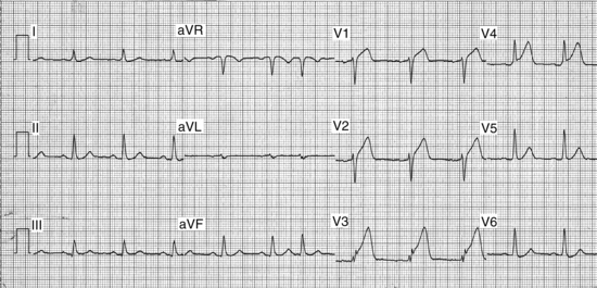 59: Continuous ST-Segment Monitoring | Anesthesia Key