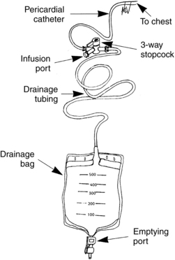 78: Pericardial Catheter Management | Anesthesia Key