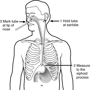 104: Esophagogastric Tamponade Tube | Anesthesia Key