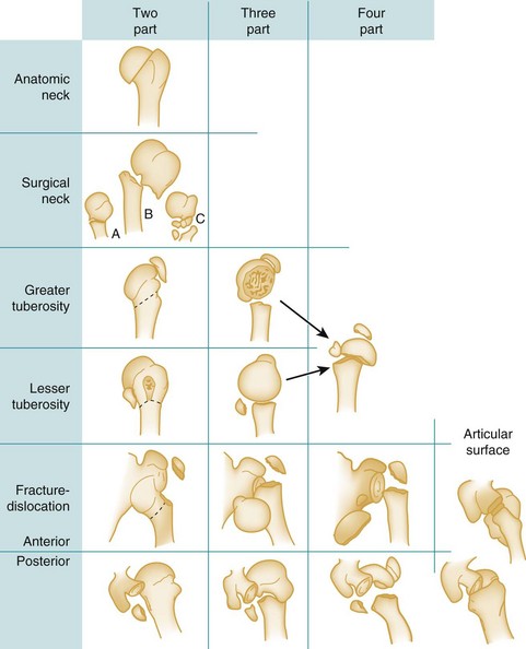 Injuries to the Shoulder Girdle and Humerus | Anesthesia Key