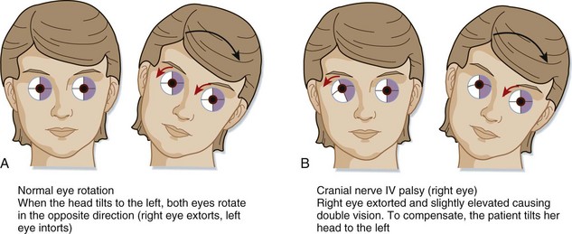 Cranial Nerve Disorders Anesthesia Key