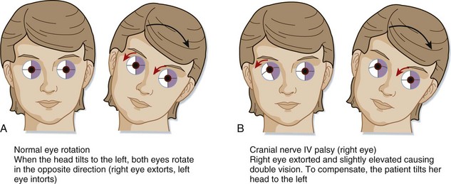 Trochlear Nerve Palsy Eye Position