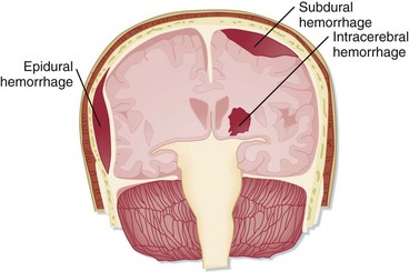Intracranial Hemorrhages | Anesthesia Key