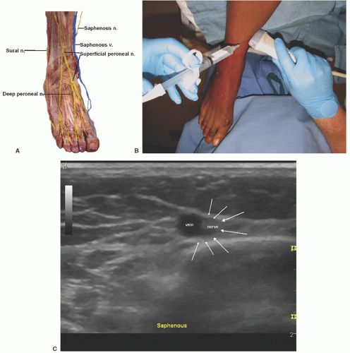 Ultrasound Guided Saphenous Nerve Block Of The Thigh Knee And Ankle