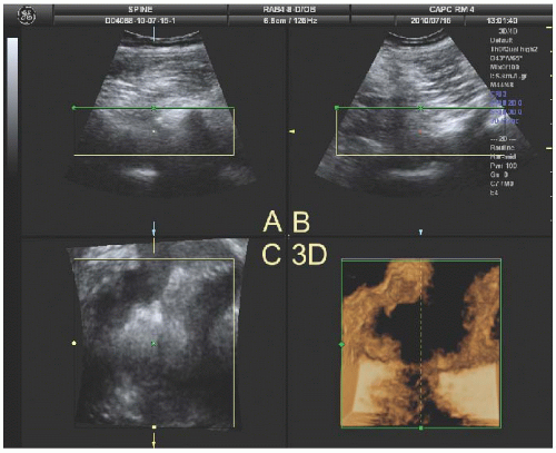 Three And Four Dimensional Ultrasound In Neuraxial Anesthesia Anesthesia Key 6566