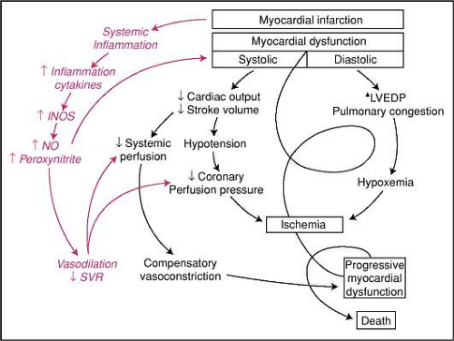 Cardiogenic Shock Complicating Acute Coronary Syndromes | Anesthesia Key