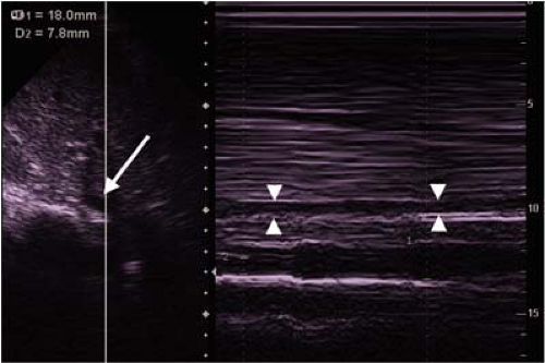 Ultrasonography in Emergency Cardiovascular Care | Anesthesia Key