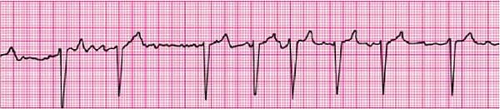 Multifocal atrial tachycardia is characterized by