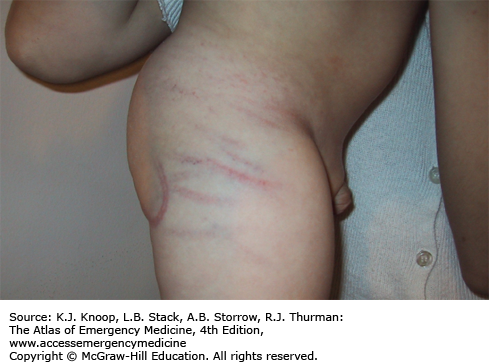 handprint bruise on arm