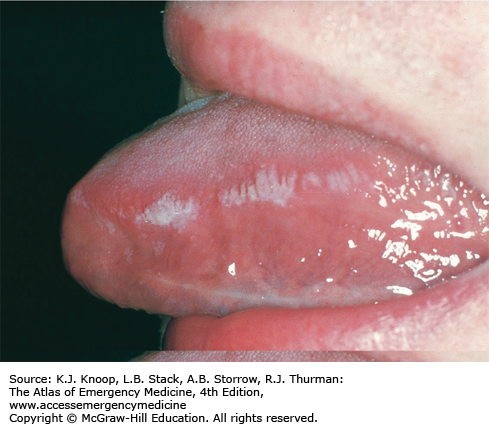 hiv bumps under tongue