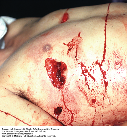 gunshot wounds to the chest