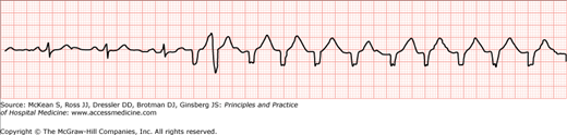 Tachyarrthymias | Anesthesia Key