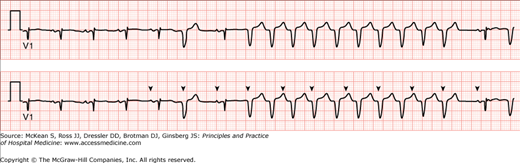 Tachyarrthymias | Anesthesia Key