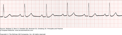 Bradyarrhythmias | Anesthesia Key