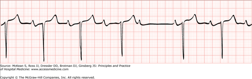 Bradyarrhythmias | Anesthesia Key