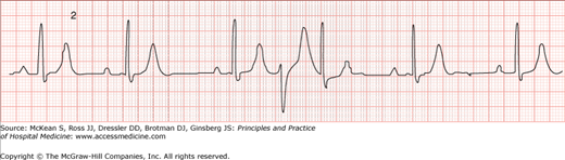 Ventricular Arrhythmias | Anesthesia Key