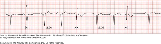 Ventricular Arrhythmias | Anesthesia Key