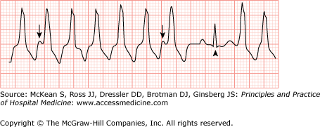 Ventricular Arrhythmias | Anesthesia Key