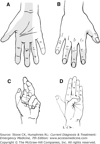 Hand Trauma | Anesthesia Key