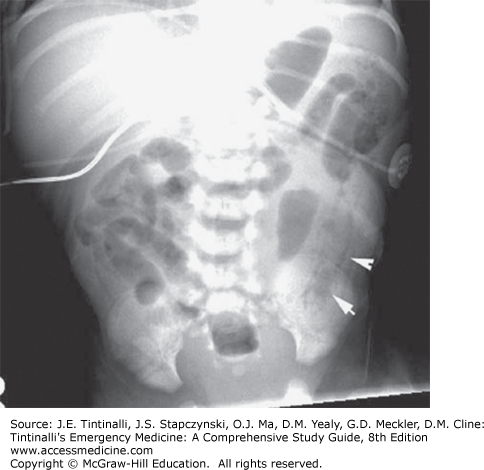 Acute Abdominal Pain In Infants And Children | Anesthesia Key