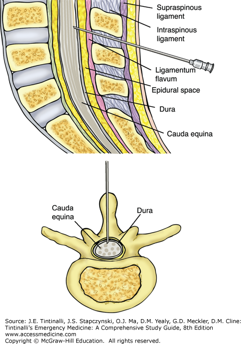 Lumbar Puncture Procedure Note Template