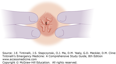 Anal Skin Tags 97