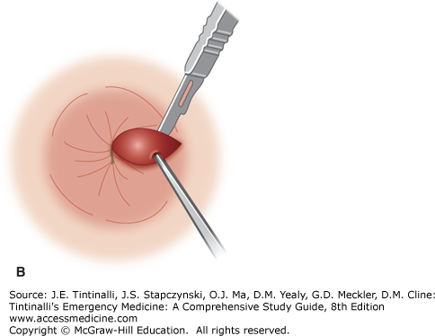 thrombosed hemorrhoid excision