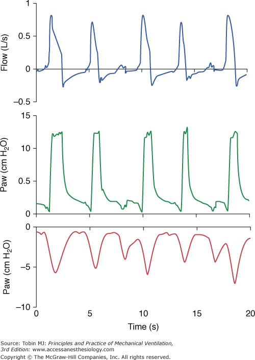 pressure-support-ventilation-anesthesia-key