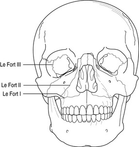 Maxillofacial and upper-airway injuries | Anesthesia Key