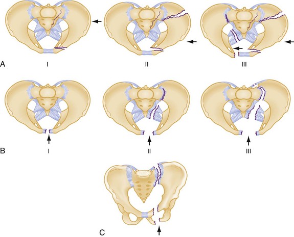 PDF] Stoppa Approach for Anterior Plate Fixation in Unstable Pelvic Ring  Injury | Semantic Scholar